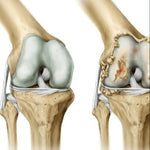 ArthroCare Pro™ X2 UNIDADES! | Bienestar articular comprobado